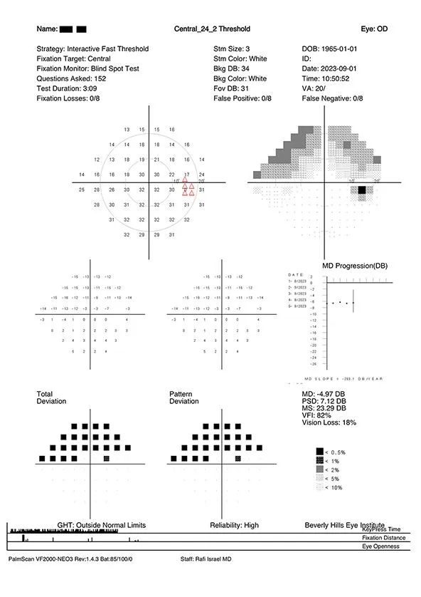 A visual field test report with charts, data tables, and graphs showing measurements of eye response, vision loss patterns, and test statistics for the right eye, including grayscale plots, numerical data, and fixation graphs.