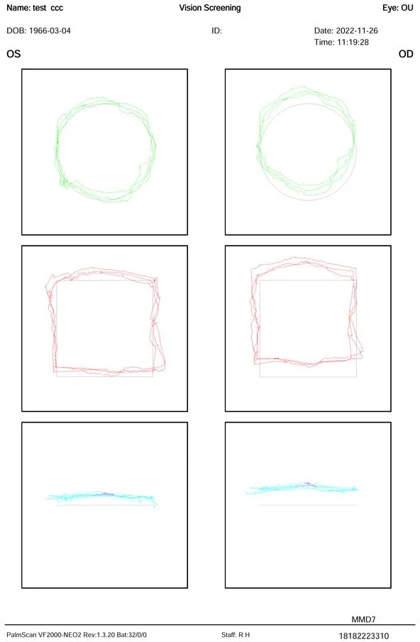 A vision screening report showing six plots—three for each eye (OS and OD). Each column contains circular, square, and horizontal line graphs, representing different eye measurements. Patient and test details are at the top.