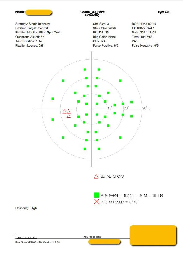 Visual field test chart with green dots, red Xs, and triangle symbols plotted on a central grid. A summary box shows test details, patient info, and reliability at the top and bottom of the image.